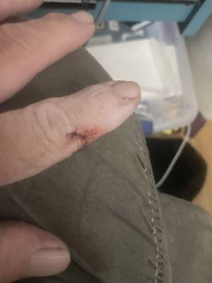 Pic of cut and stitches.