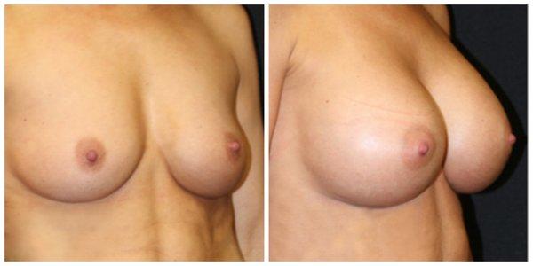 Natural looking Breast Augmentation (with Gel Implants) from $120/month (5 years). 0% financing and no credit check payment plans available.