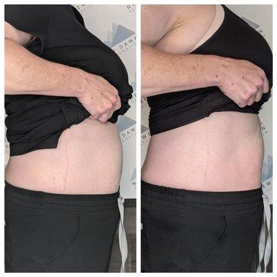 1 Treatment of CryoSlimming