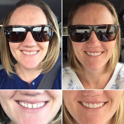 6 new veneers