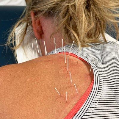 Dry needling can really help with shoulder pain