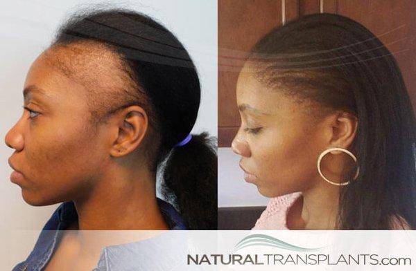 Natural Transplants, Hair Restoration Clinic