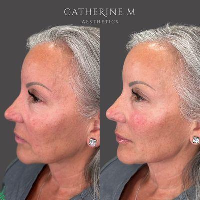 Liquid Facelift using filler.