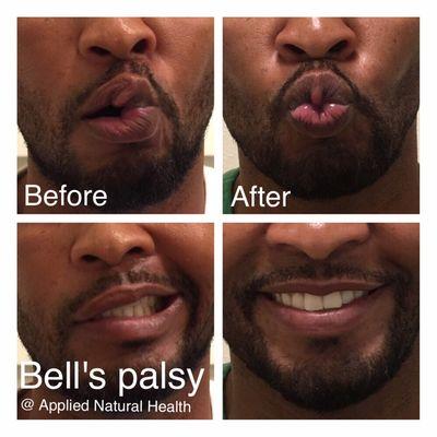 Bell's palsy recovery with acupuncture and electro-stimulation. Regain your normal facial expression and get that great smile back!