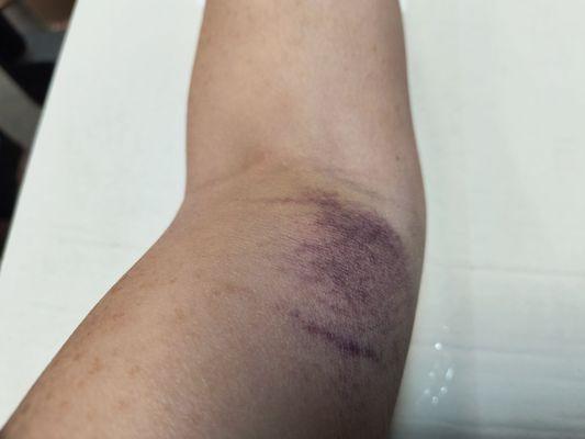 My arm all bruised the day after drawing blood