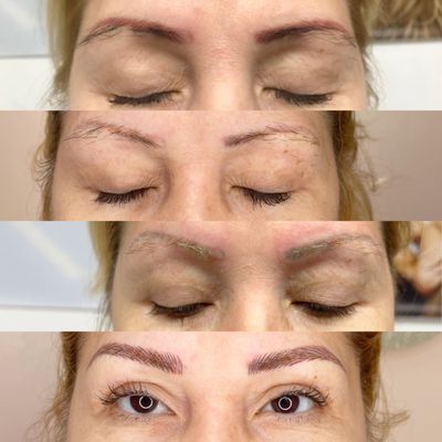 Permanent make up removal / eyebrows microblading