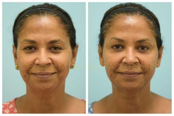 This 54-year-old female is shown before and two weeks after Botox and fillers with Dr. Lam.