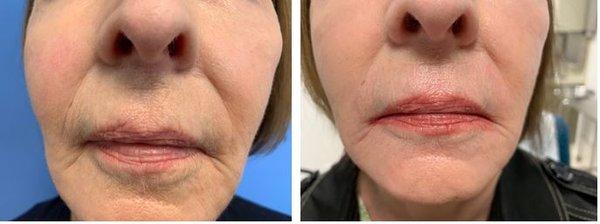 Before and After One Plasma Pen Fibroblasting Treatment