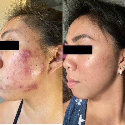 Tucson Acne Clinic