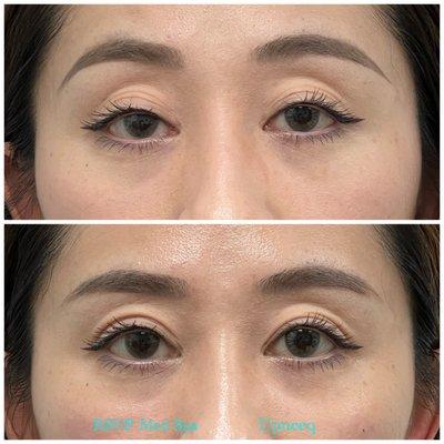 Upneeq before and after for low lying eyelids