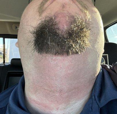 My neck after trim with dull clippers