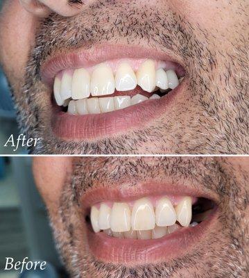 Implant treatment, upper left.