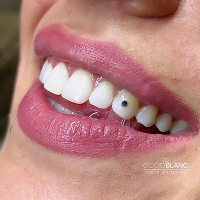 Tooth Gems are a great touch to a white smile