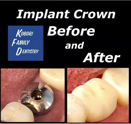 Implant Crown