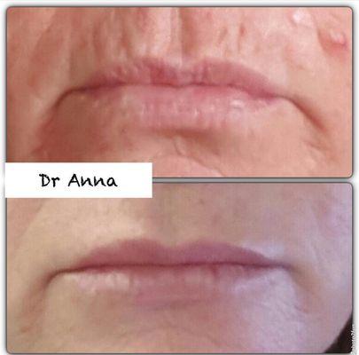 Eliminate the smoker's lines and add subtle lip volume with dermal fillers.