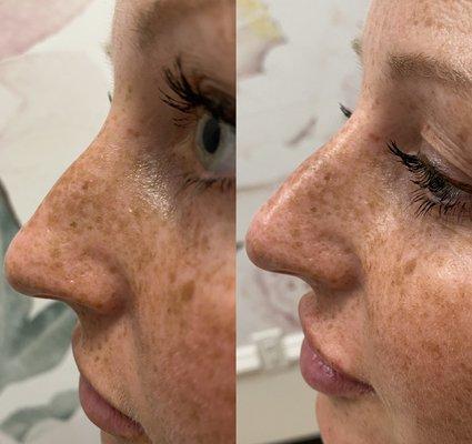 Nose filler by Galena Neal