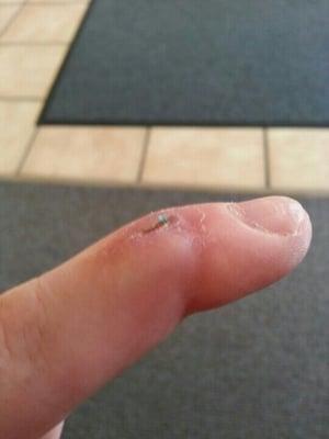 Currently here for another follow-up on my finger. The bluish thing is an internal stitch poking out.