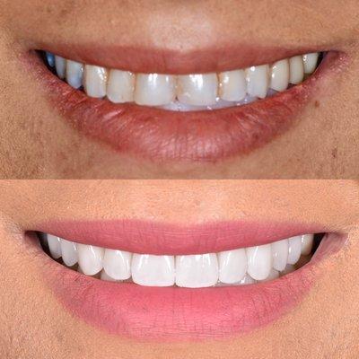 10 Upper Porcelain Veneers- Natural Design  Call for a virtual consultation.