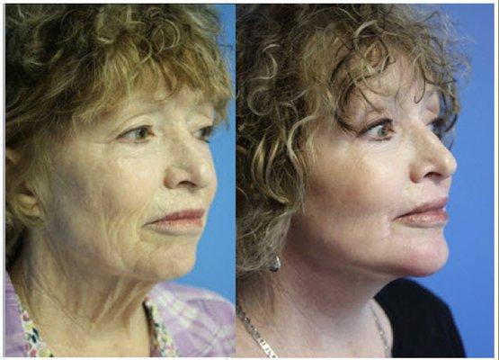 Facelift & Browlift