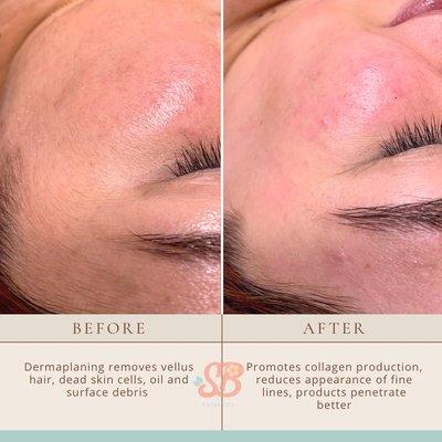 Before & After - Dermaplaning