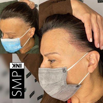 Microblading in the hairline