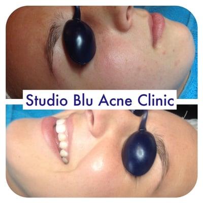 Before/After Studio Blu Acne Clinic