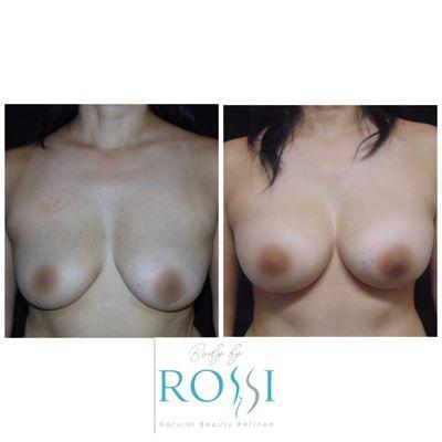 Beautiful dual plane silicone Breast Augmentation