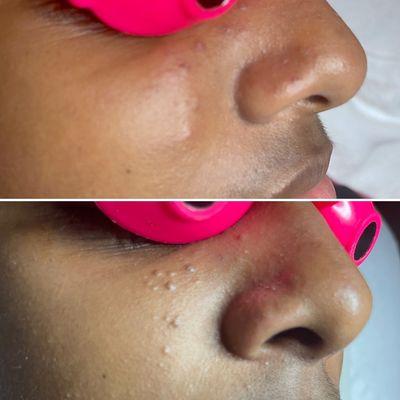 Before and after one treatment of clarity facial