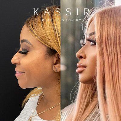 After Designer Rhinoplasty® and Chin Augmentation