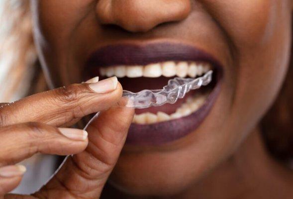 Invisalign can straighten teeth and prevent problems caused by crooked teeth, including overcrowding and decay.