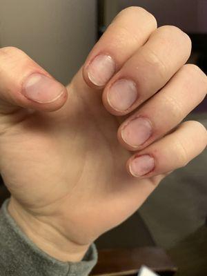 My nails after an hour of waiting for them to be removed.