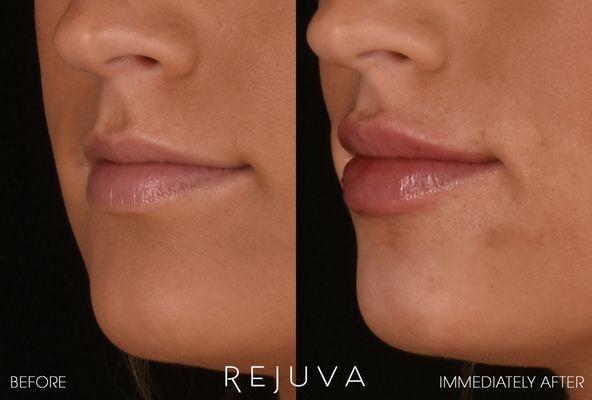 Lip Augmentation before & immediately after with Restylane Kysse, performed by Natalia Guzman RN, BSN, CANS