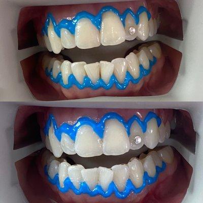 Cosmetic Teeth Whitening Session!