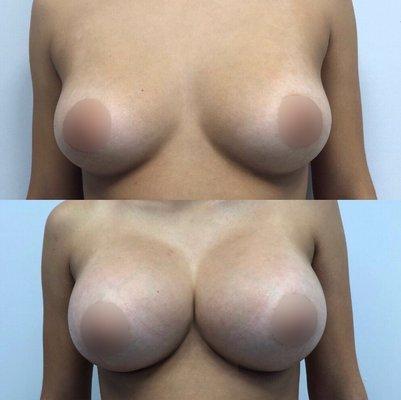 Breast Enhancements