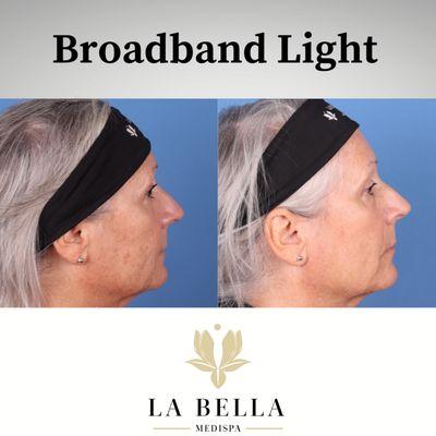 Broadband Light before and after treatment