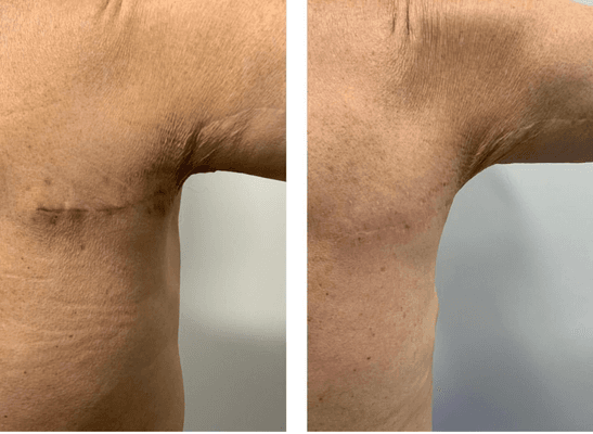 These amazing  results were achieved with just 3 sessions of Cynosure Icon 1540 fractional laser.