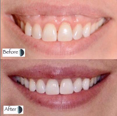 Lip Repositioning to correct a gummy smile