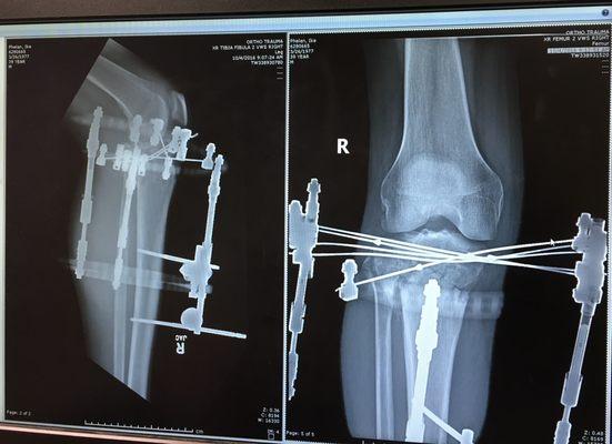 Halo put in by Dr. Chronister which allowed full range of motion on a shattered knee.