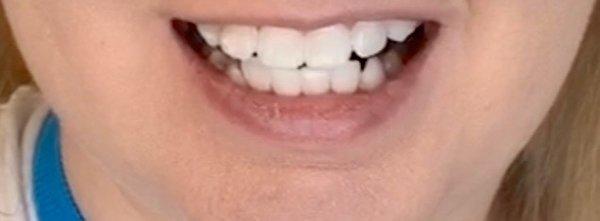 After whitening