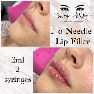 No Needle Lip Filler 2 Syringes