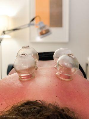 Cupping for upper back tension and pain