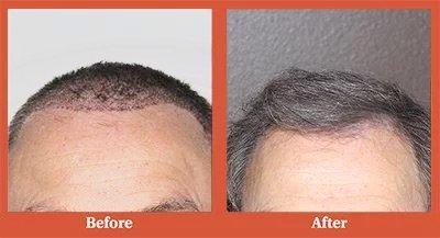 Dr. Simon of Vegas Valley Hair Restoration - Before and After photo