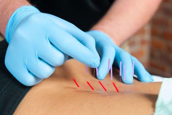 DRY NEEDLING is the acupuncture style I got and Dr. Mick helped my back pain with it!