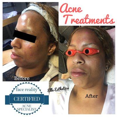 See improvement after one treatment. More treatments may be needed to achieve the desired result.