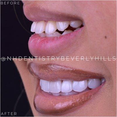 Veneers