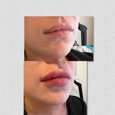 Full syringe of Lip filler before and after