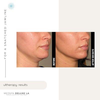 Ultherapy for skin tightening under the chin for a more defined jawline