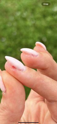 Raw, bloody, painful nails that are misshapen with gel in the cuticle