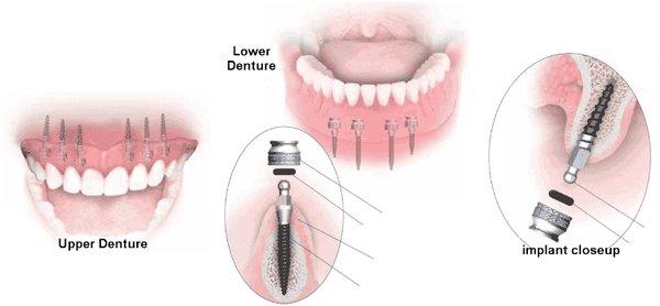 4 Mini implants implanted in the jaw bone to stabilize permanent removable dentures for total of as low as $3500.