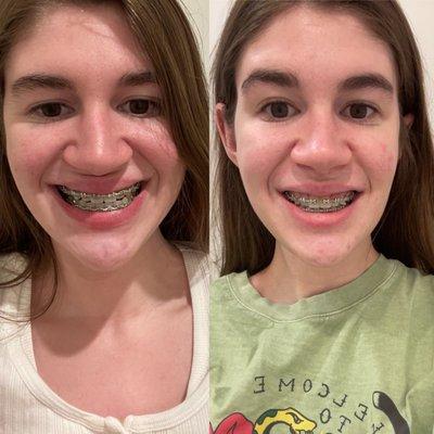 Left before right after. You can see so much more of my top teeth when I smile, which is something I've wanted ever since i was a kid